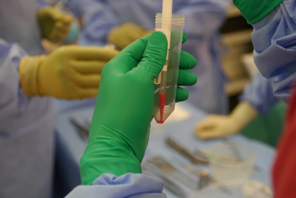 Private cartilage cell therapy at London Cartilage Clinic