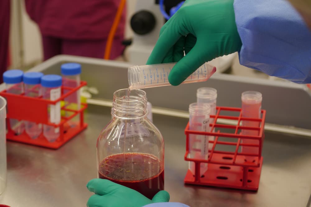 Cartilage cells prepared for implantation at London Cartilage Clinic