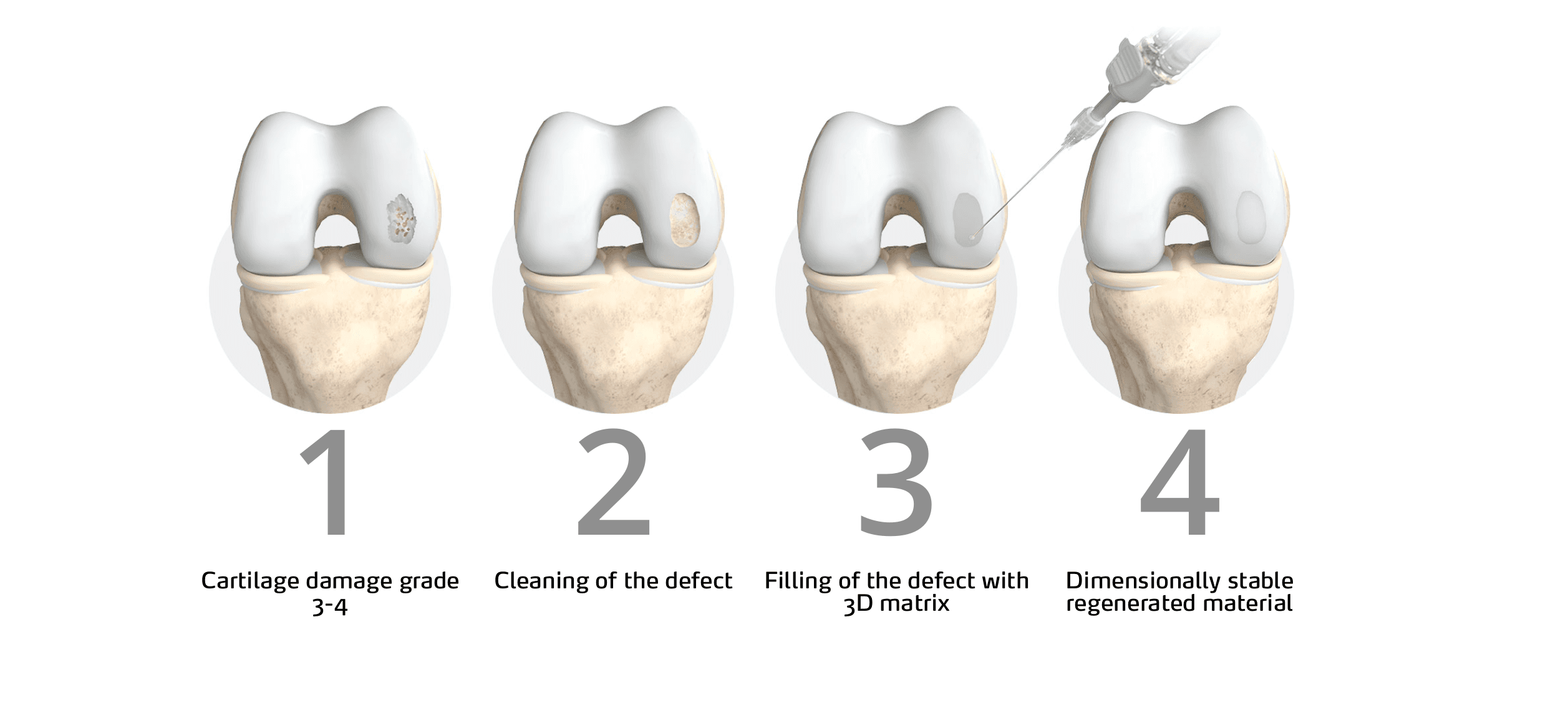 ChondroFiller cartilage regeneration mechanism illustration